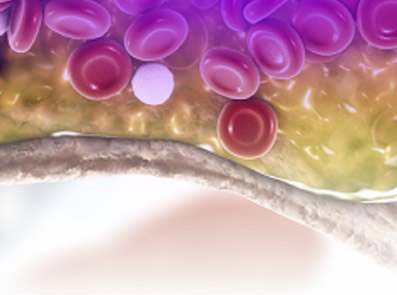  artera cu placa de aterom